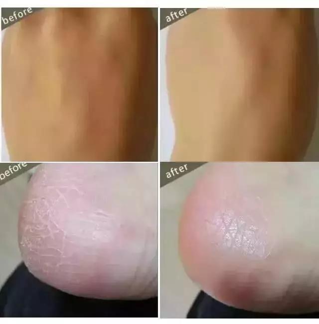 女生冬天腿上为什么会鸡皮肤很痒