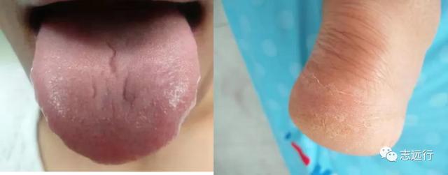 角化形手癣中药熏洗方