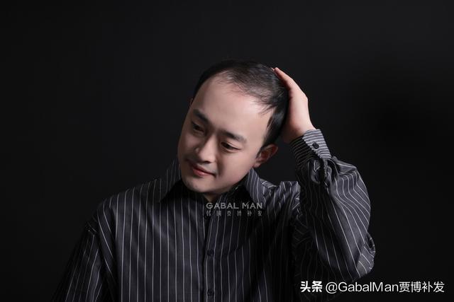 额头高怎么办