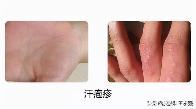 汗疱疹反复性发作，瘙痒难耐，医生教你用3个方法解决，快速有效