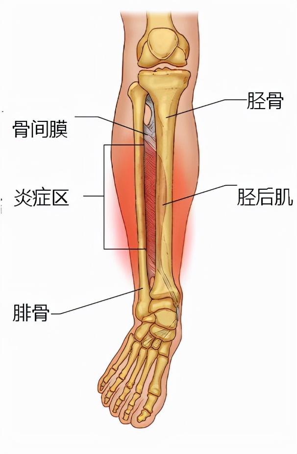 孩子没跑多久就出现小腿胫骨疼痛，这是怎么回事？还能运动吗？