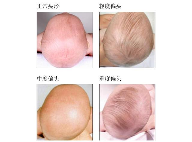 睡姿不当会导致新生儿头骨变形 不少新手妈妈还不懂 及时纠正 全网搜