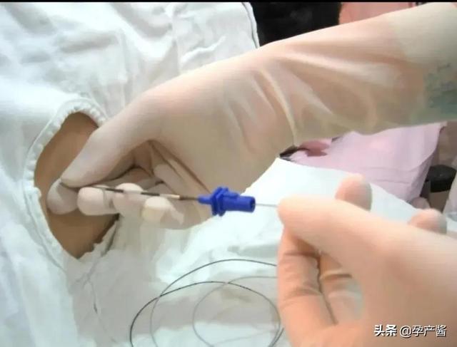 第一篇《我的剖腹产日记》:医生按肚子按到我肋骨，我直接飚泪