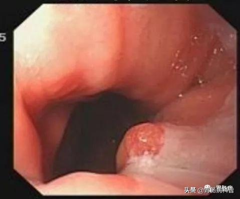 食道癌部分角化