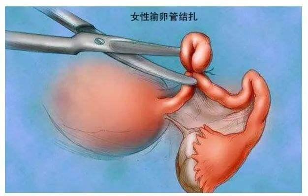 做过结扎现在还可以做回输卵管互通手术吗?