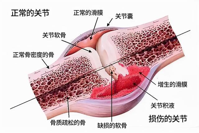 秋季来临，天气慢慢转凉，骨关节炎患者，该如何保养关节呢？