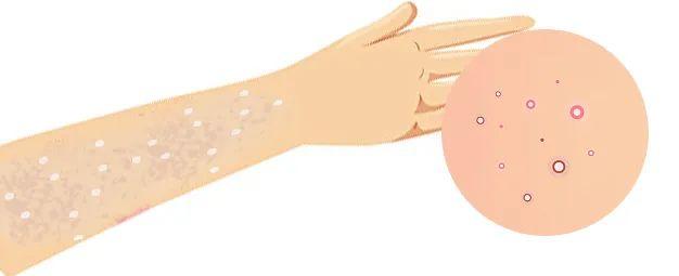 “多事之秋”谨防皮肤病侵扰