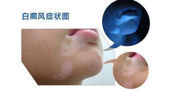 四岁宝宝肚子上有白点像鸡皮肤