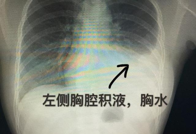 癌症患者最怕遇到“恶液质”，为什么？应该如何有效防治呢？