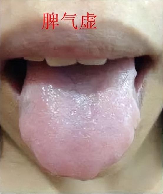 舌象分析，看看正常的和异常的舌象对比