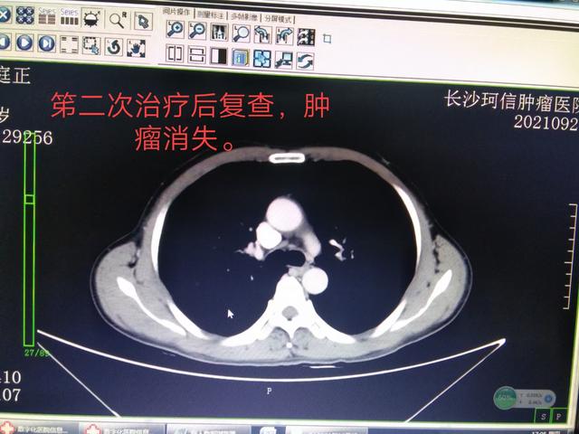 肺部鱼鳞癌的化疗要几个疗程