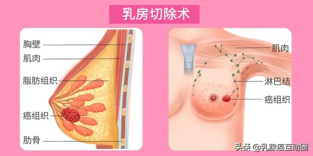 我，20歲，確診三陰乳腺癌