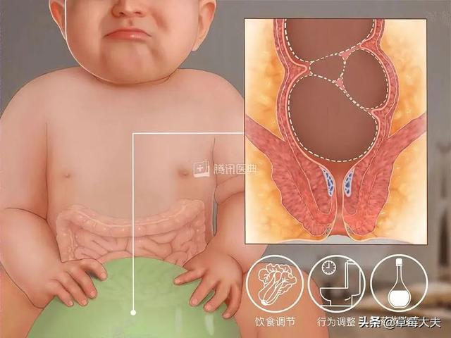 出生无肛门，肚子气球大！“气球宝宝”在草莓医院挺过来了