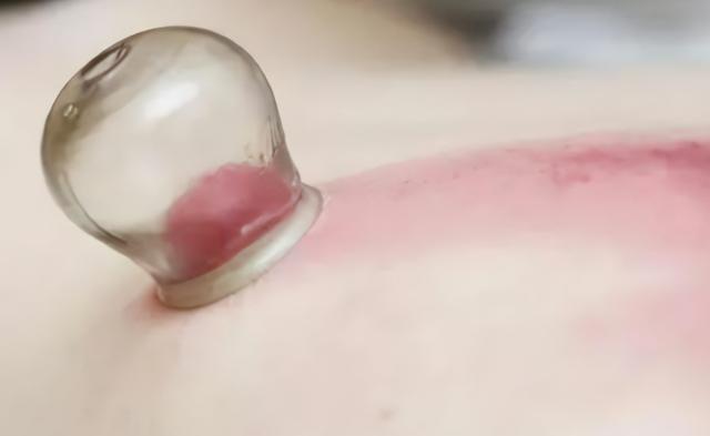 拔罐后的罐印颜色越深，代表湿气越重？医生提醒：别被传言误导了