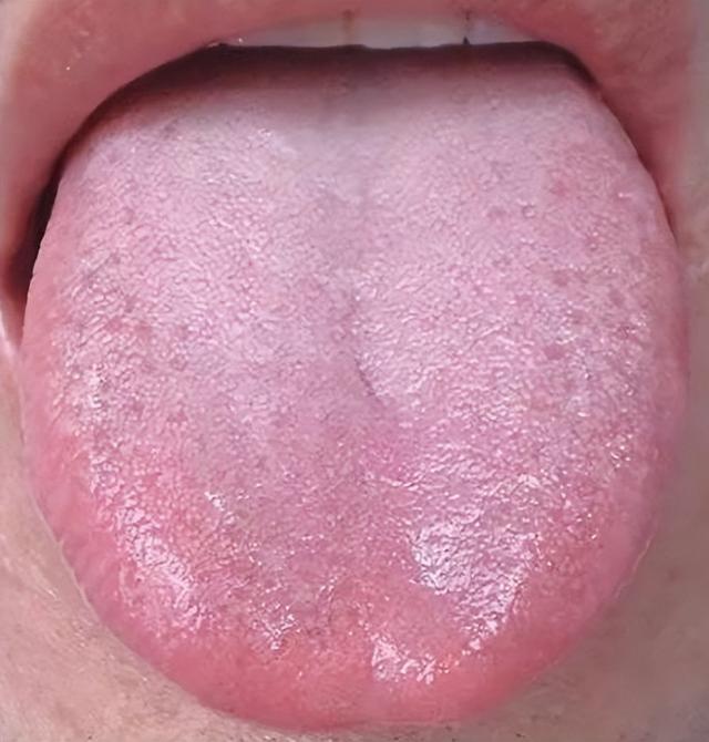 舌苔厚腻且有齿痕，是什么问题？教你看舌苔辨健康