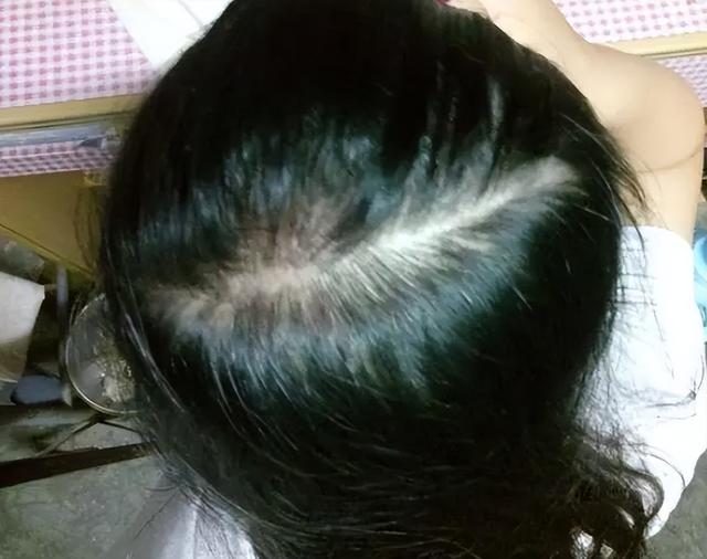 头皮上经常长脓包和疙瘩，是怎么回事？医生：3种病要考虑在内