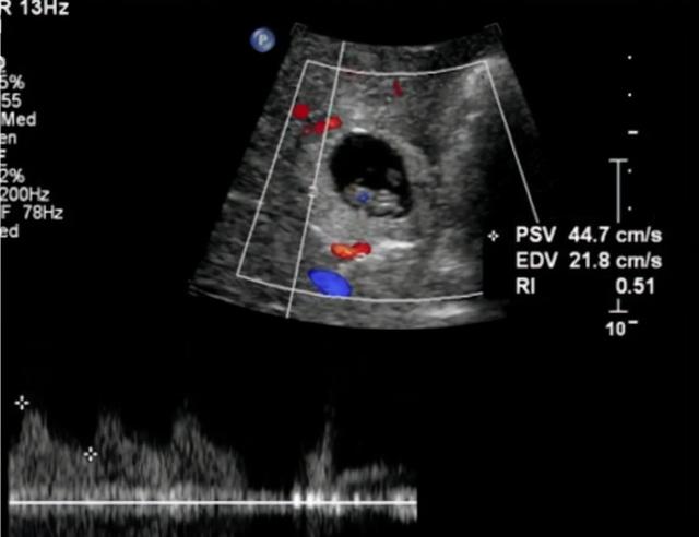 全球不足30例！广西一女子怀孕，胎儿却长在肝脏里，能生下来吗？