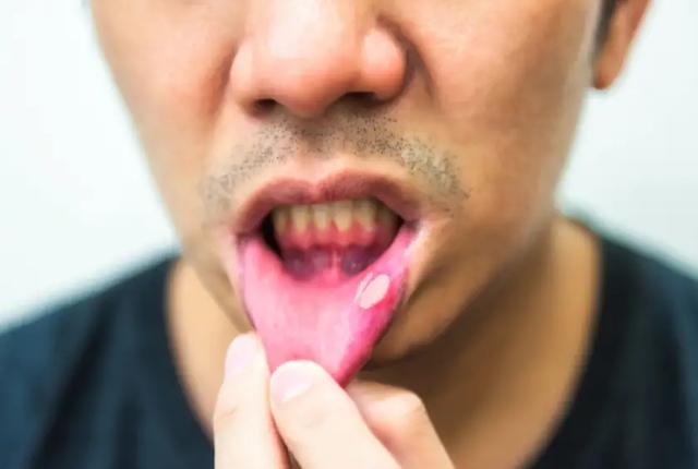 上火？牙龈肿痛、口唇干燥，中医送你一味栀子全都搞定