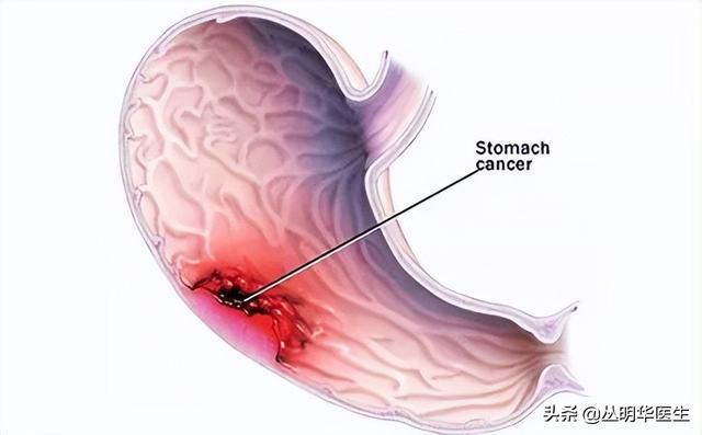 胃癌患者化疗期间营养窍门