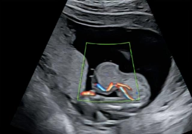 全球不足30例！广西一女子怀孕，胎儿却长在肝脏里，能生下来吗？