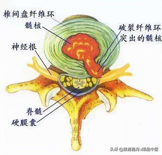 肩膀疼痛!不一定是肩周炎,有可能是神經根型頸椎病_健康症狀網