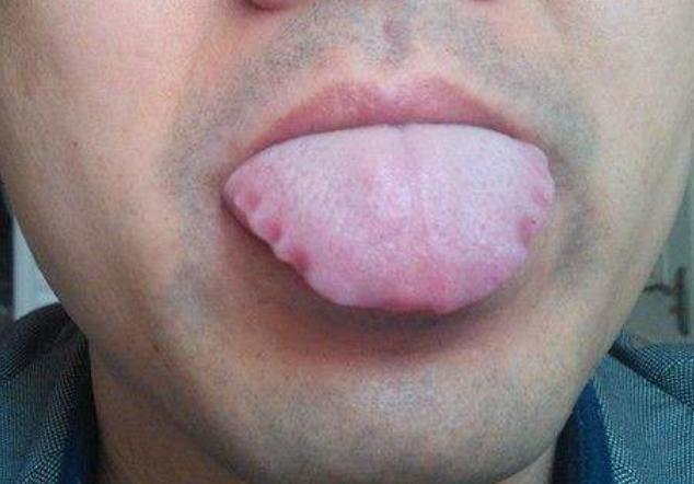 咽炎咳不出咽不下，吃消炎药没用？3类情况要分清，看你是哪一类