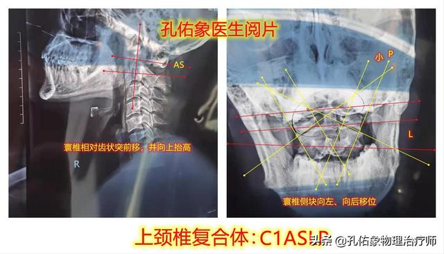 肩胛骨疼痛、手麻、整天头昏脑胀，是更年期综合症吗？不要被糊弄
