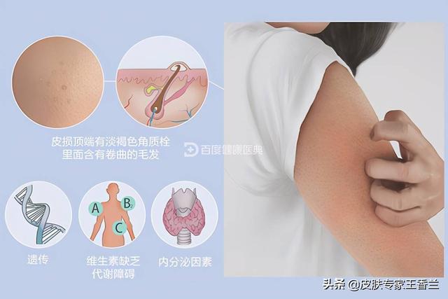 毛周角化可以使用脱毛仪吗