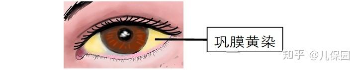 秋天来了，树叶黄了，宝宝为啥也黄了？