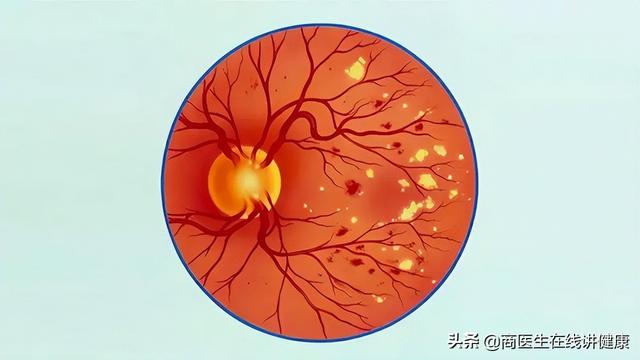 65岁陈叔因血糖过高死亡，医生提醒：这3种素食，糖友需尽量少吃