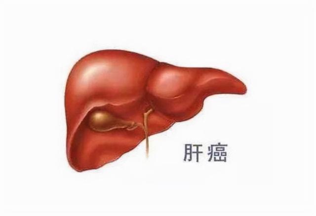 医生：请停止饮用“1桶装水”，或加快肝癌到来，建议早了解