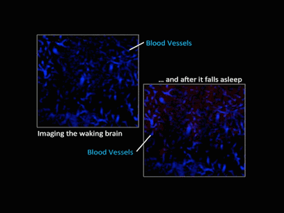 注意！只有睡眠可清扫你脑中的垃圾！睡眠不足会让人变傻、变痴呆