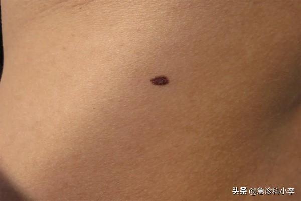 胳膊上好多小红点