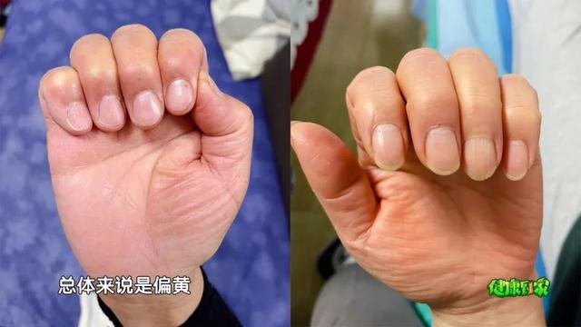 手指甲满足3个特点，多半是身体在“求救”！赶紧自测