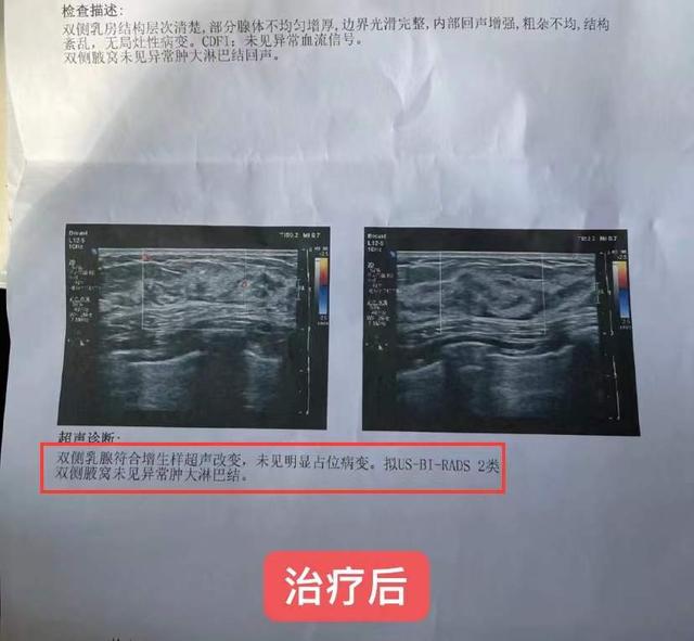 母乳喂养有后遗症？33岁女子查出乳腺结节3类，医生：别大意