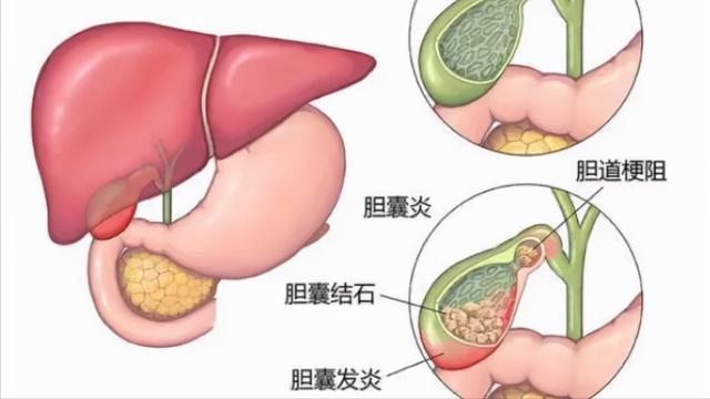 别再把消化不良当胃病！或许是胆囊不好了，听听医生怎么说