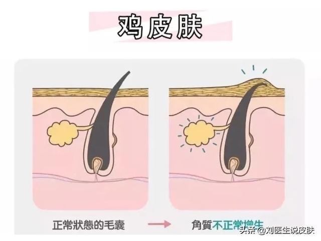 皮肤起鸡皮眼