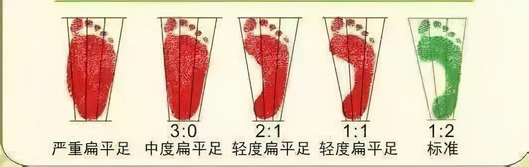 足外翻一定会伴随着扁平足,所以在医院,医生会采用足印法,足底压力