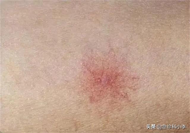 胳膊上好多小红点