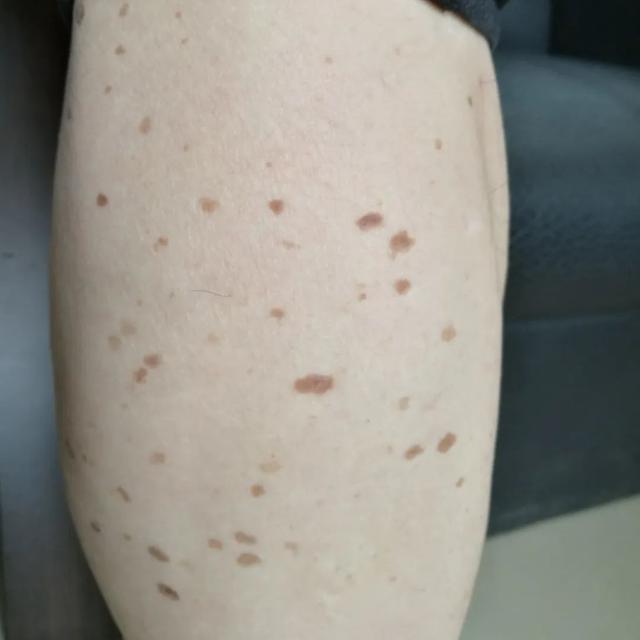 手心透明疙瘩点状角化病