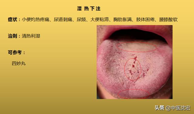 4种“热”藏于体内，不同舌象，不同症状，建议收藏分享给朋友