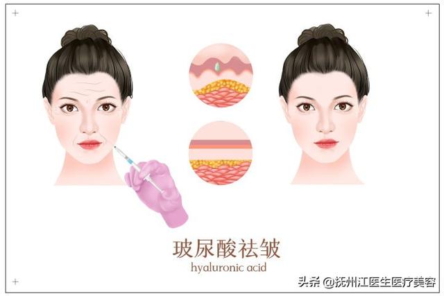 法令纹怎么去除最有效安全（特别严重的法令纹怎么改善）