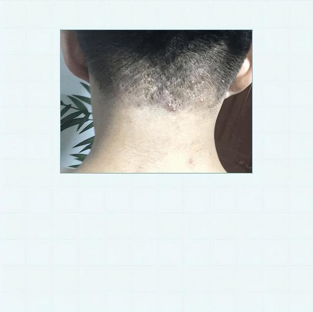 抠头上脂肪粒头上有脂肪粒怎么回事