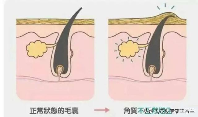 怎样除掉脸上的鸡皮肤