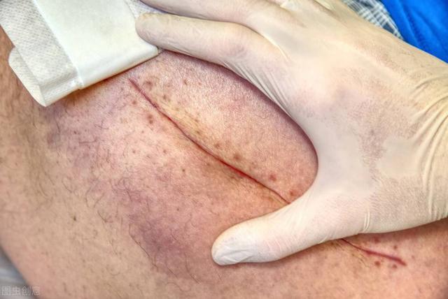 手術1年后就復發轉移了？我這是白切了？