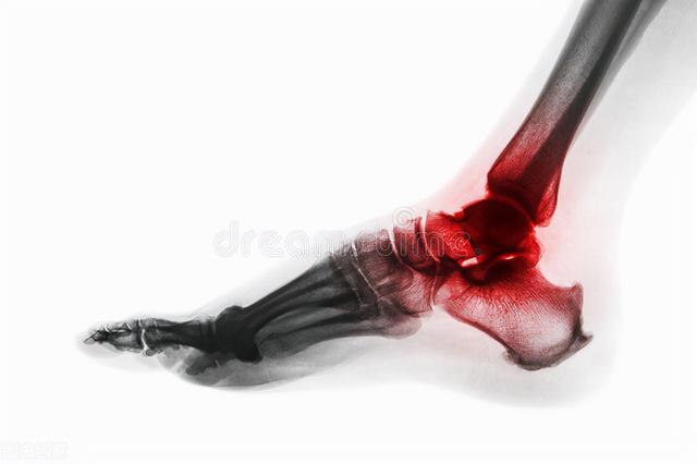 「医案」类风湿关节炎有哪些症状？中医如何调理？
