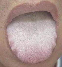 舌苔白厚腻
