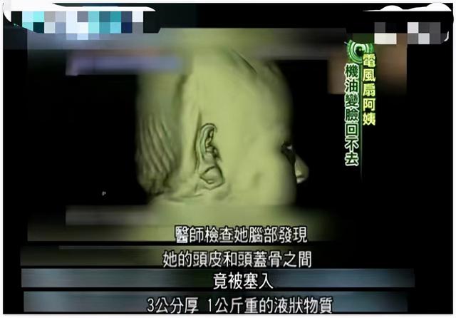 韩慧景：把自己整成“电风扇”，注射食用油代价惨痛，我悔不当初