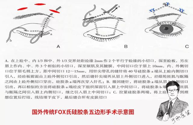 五年八部曲，上睑下垂分阶段治疗的故事