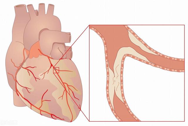 四大心脏病最怕什么呢？